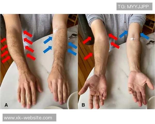 李磊右大腿后群肌肉拉伤及肌筋膜炎I的伤情报告分析与康复建议 李磊右大腿后群肌肉拉伤及肌筋膜炎I的伤情报告分析与康复建议